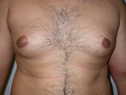 before male breast enlargement